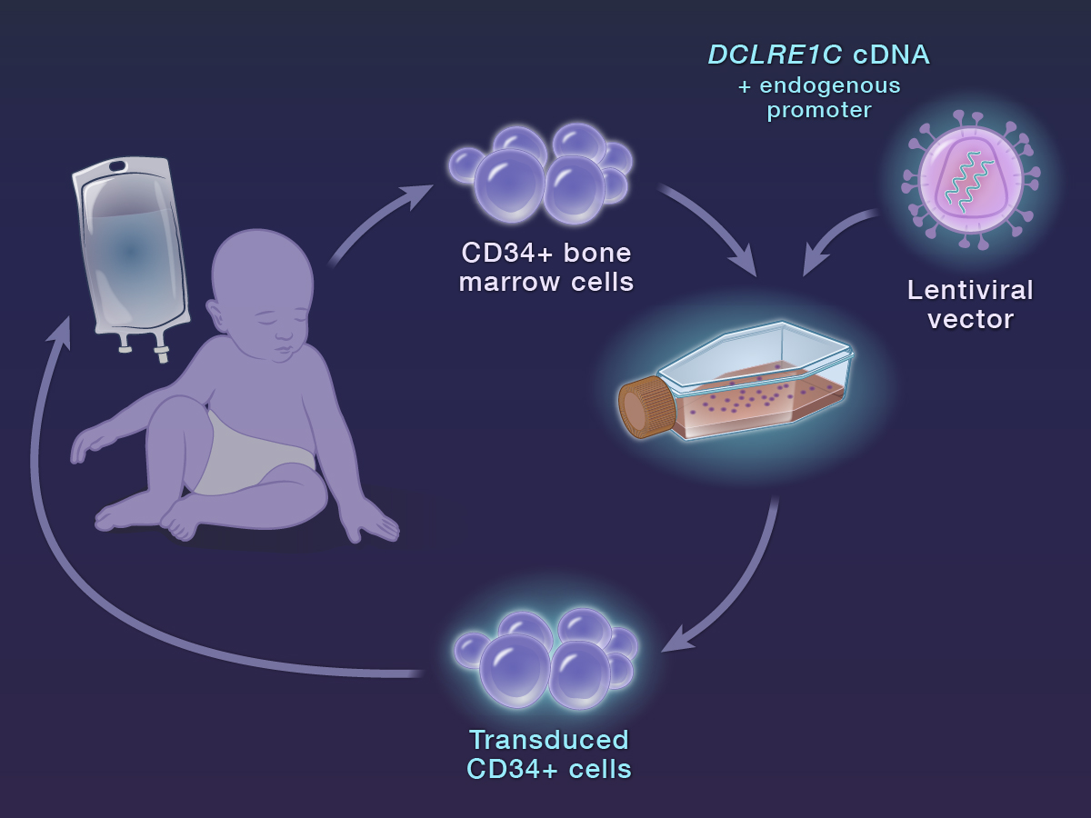 An interim analysis of a phase 1–2 study of gene therapy for Artemis-deficient severe combined immunodeficiency suggests that this treatment is safe and effective. New research findings are summarized in a short video.