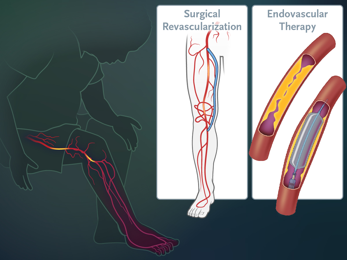 Patients with chronic limb-threatening ischemia require timely revascularization, but whether clinical outcomes are better with surgical bypass or endovascular therapy is unclear. New research findings are summarized in a short video.