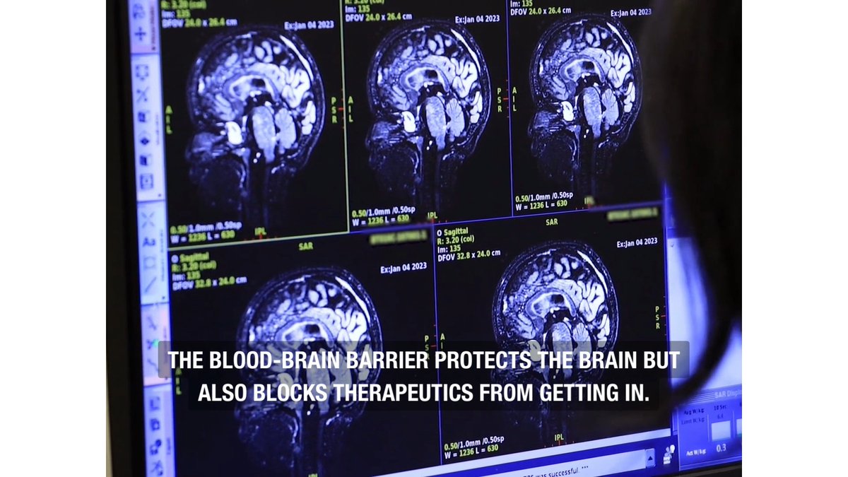 World-first: Sunnybrook and The Hospital for Sick Children (SickKids) are the first in the world to use MRI-guided focused ultrasound to deliver chemotherapy in Diffuse Intrinsic Pontine Glioma, an aggressive and terminal pediatric brain tumour. Read more about the trial: