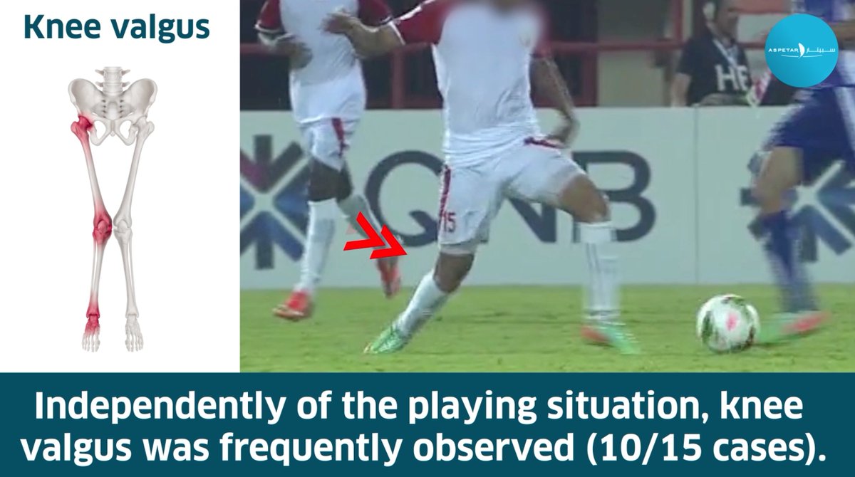 🦵📽️ Mechanisms of ACL injuries in men’s football: A systematic video analysis. ✍️ Raouf Nader Rekik Roald Bahr Flavio Cruz, Paul Read Rod Whiteley Pieter D'Hooghe Montassar Tabben & Karim Chamari 🔗#OpenAccess 👉