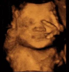 Approximately 75% of women at-risk for abortion who view an ultrasound of their baby at a pregnancy center ultimately make the choice to continue their pregnancy.