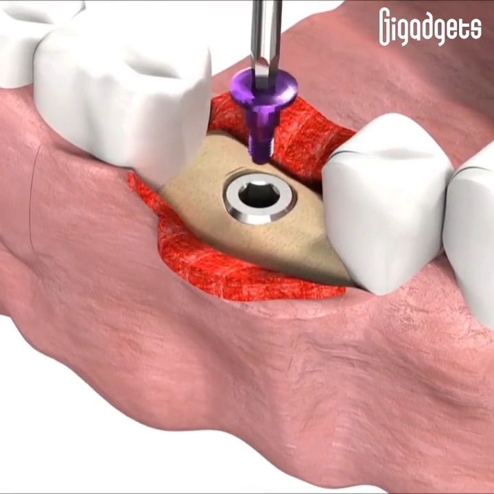 This is the manner in which a dental implant is inserted. Credit: SICinvent