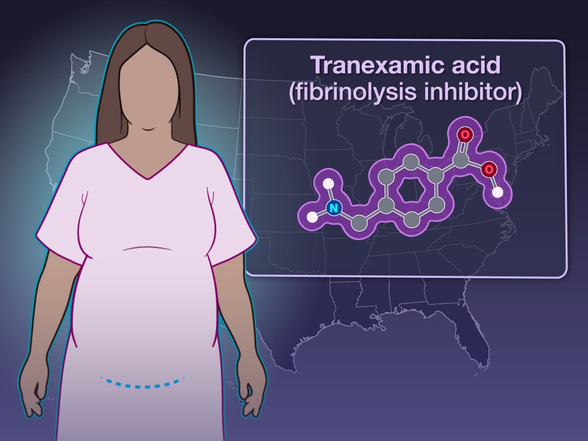 Use of tranexamic acid after cesarean delivery has been shown to reduce estimated blood loss, but its effect on important clinical outcomes is unclear. New research findings are summarized in this short video.