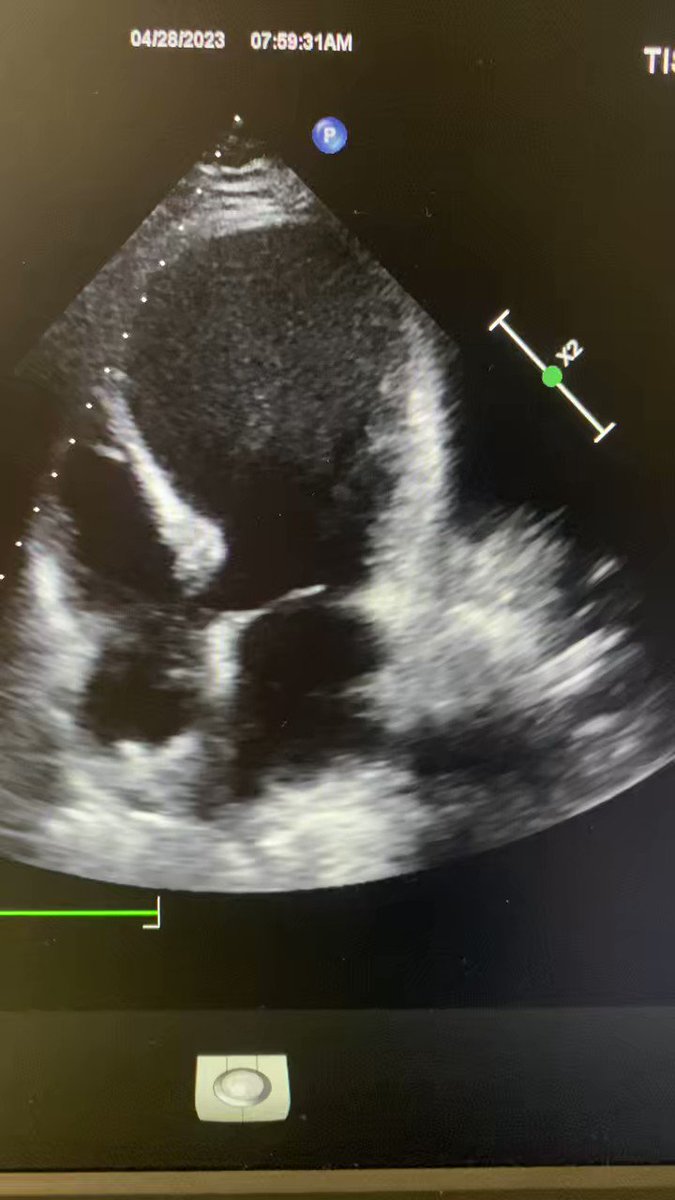#echofirst #CardioTwitter #apicalaneurysm how much is the EF ? 15% 18% 20% ??