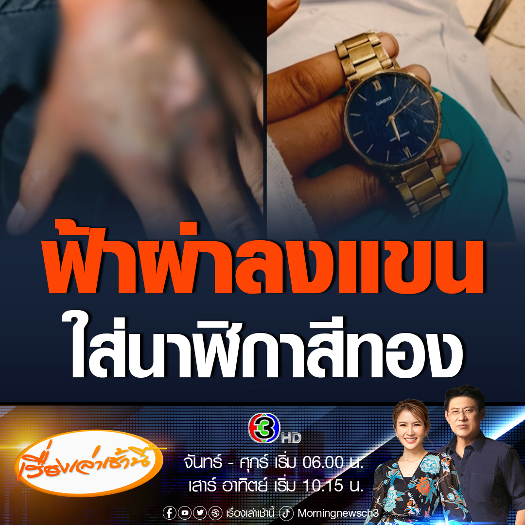 #เรื่องเล่าเช้านี้ หนุ่มโพสต์อุทาหรณ์ฟ้าผ่าลงแขน เชื่อเหตุใส่นาฬิกาสีทอง ต้องแอดมิดนอนโรงพยาบาลดูการเต้นของหัวใจ เพราะโดนกระแสไฟฟ้ามีผลกระทบต่อหัวใจ #ข่าวช่อง3 #ข่าวสังคม #พายุฤดูร้อน #ฟ้าผ่า