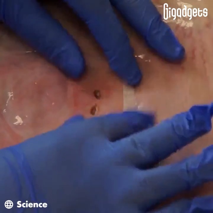 MIT researchers developed a surgical tape that works like a Band-Aid for internal organs. GiGadgets Massachusetts Institute of Technology (MIT) #MedEd #MedTwitter #surgery #science #technology