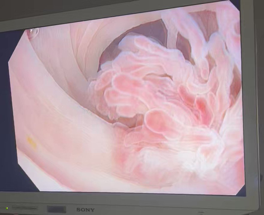 Incidental finding on colonoscopy. What would you do?