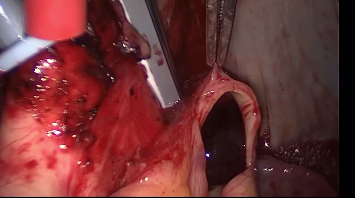 Removal of this massive 11 inch long PULMONARY EMBOLISM resulted in patient survival &amp; a great outcome. Source: Erik Beyer