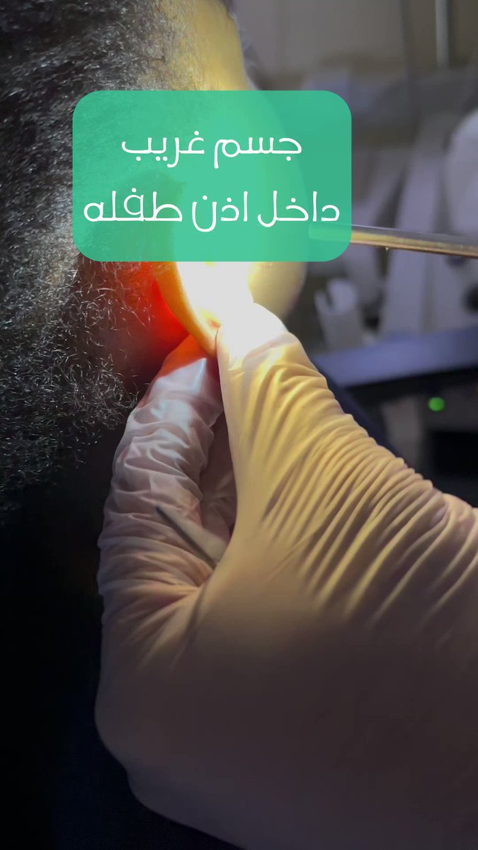 (جسم غريب) داخل اذن طفله ! 👂 دائما نحذر عدم ترك الأجسام الصغيره حول الأطفال 🛑 #اذن #اطفال #مدونة_طبيب