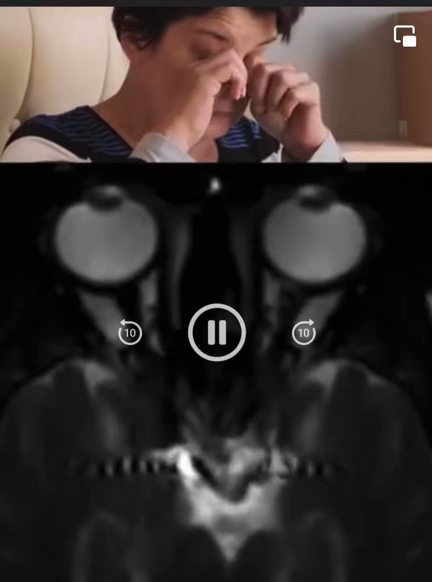 Striking Impact of Eye Rubbing on Anatomy
