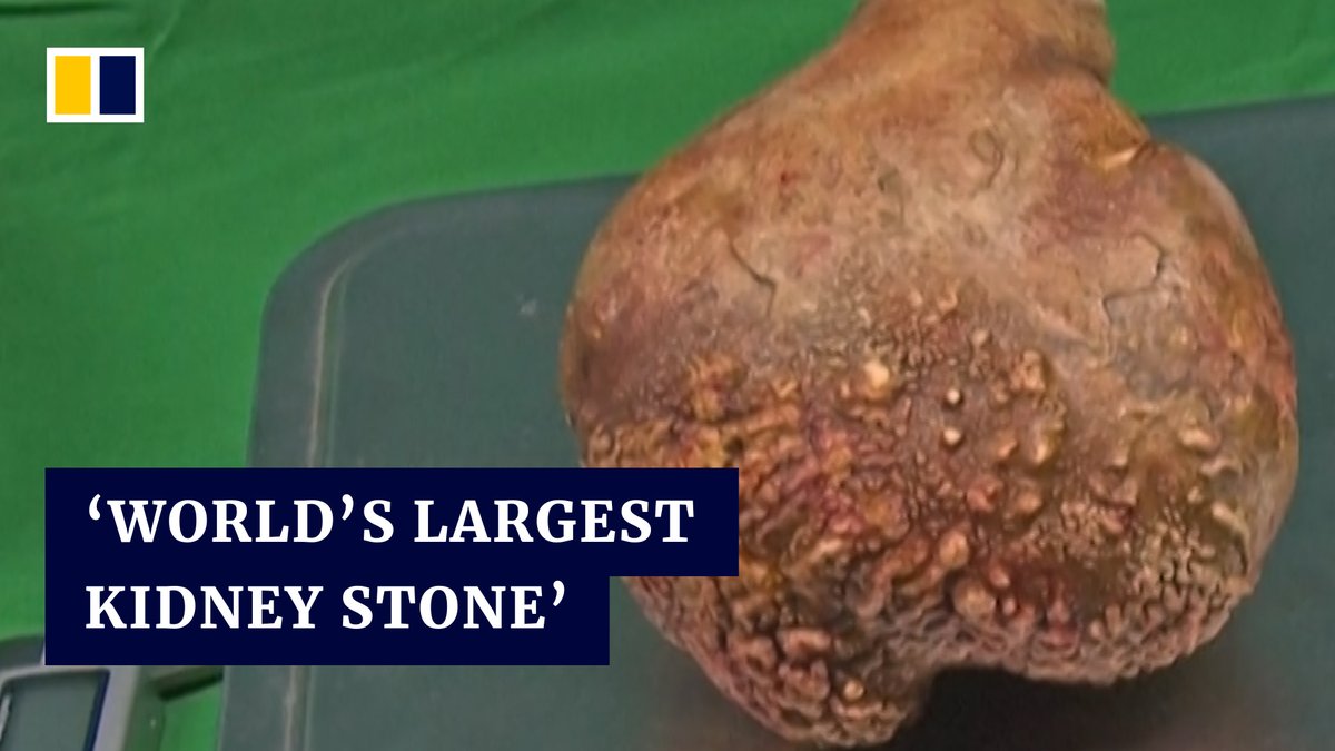Military doctors in Sri Lanka removed what’s been confirmed by the Guinness World Records as the world’s-largest kidney stone on June 1, 2023.