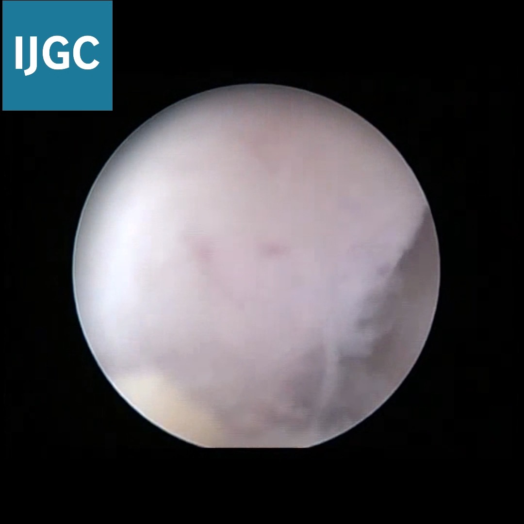 Check out this incredible hysteroscopic view of #EndometrialAdenocarcinoma by Dr. Fernando Hidalgo Dr. Fernando Hidalgo , MD FACS 🇻🇪 🎥🔬#IJGCvideo #MedicalResearch Pedro T Ramirez Arthur_HC_Hsu Aarthi S Jayraj Andreina Fernandes Ane Gerda Z Eriksson MD PhD IGCS ESGO IJGC Fellows Houssein EL HAJJ