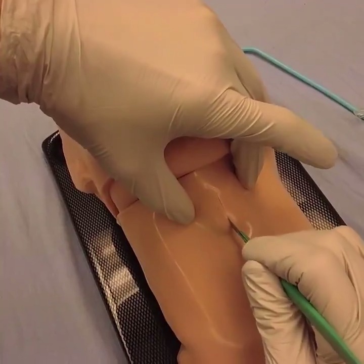 Scalpel-finger-bougie cricothyrotomy The Gurney Room Team #FOAMed