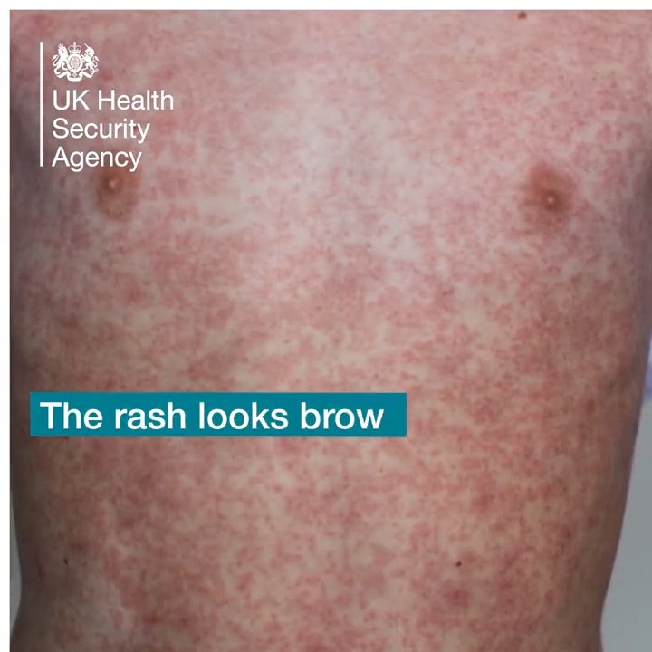 #Measles can be a serious infection that can lead to complications, especially in young children &amp; those with weakened immune systems. Measles spreads easily but it is preventable. Make sure you &amp; your loved ones are up to date with your #MMR jabs or catch up on any missed jabs.
