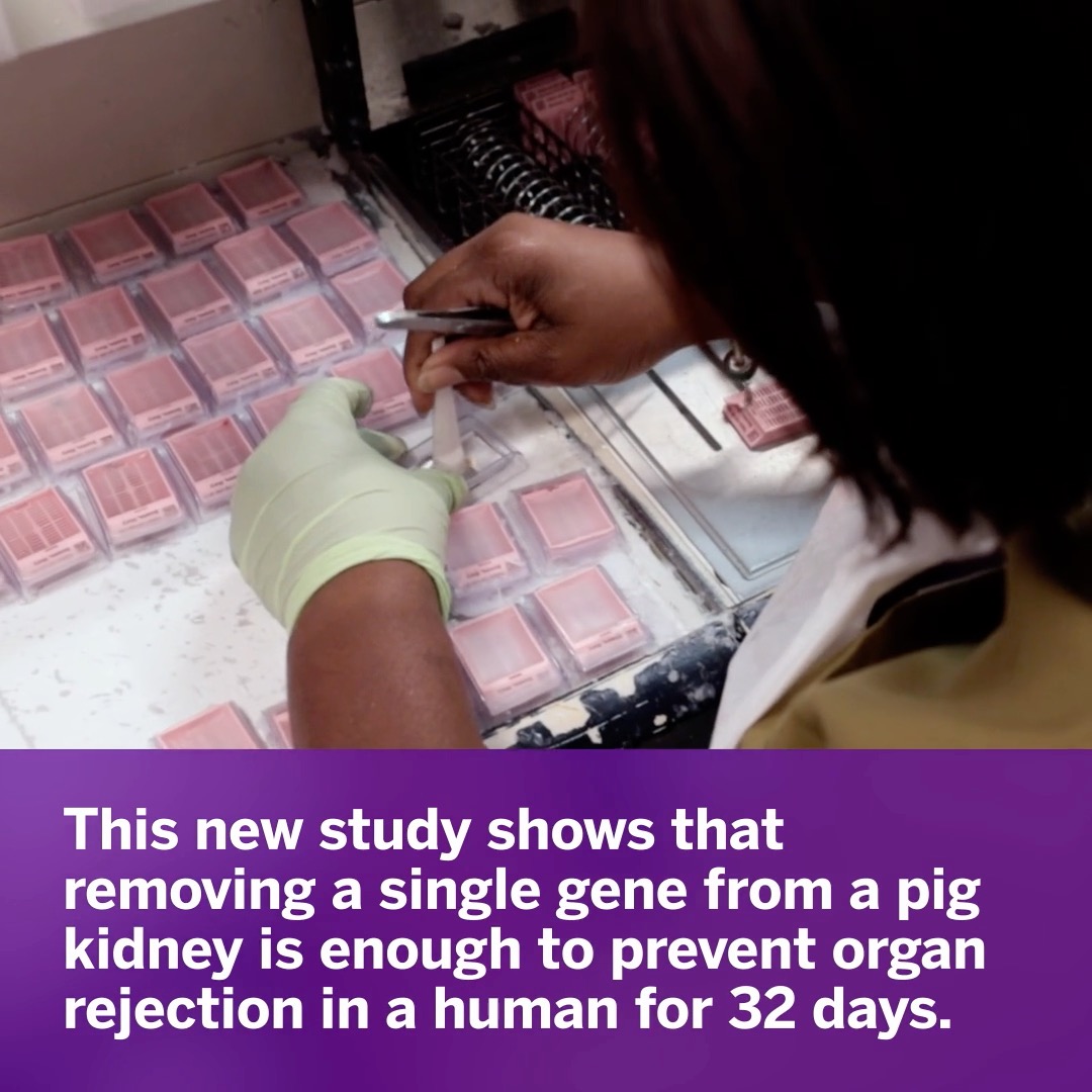 Researchers have reached a new milestone in the future of organ transplantation: a modified pig kidney transplanted into a human has been successfully functioning for 32 consecutive days. Learn more about Dr. Robert Montgomery’s research: