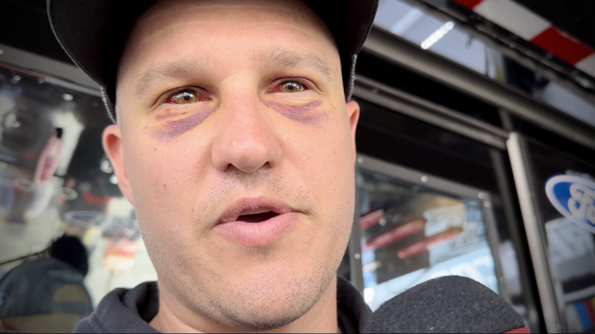 Ryan Preece takes off his sunglasses to show reporters his eyes. He said he has no vision issues. It is typical after a flip like that to have blood vessels burst.