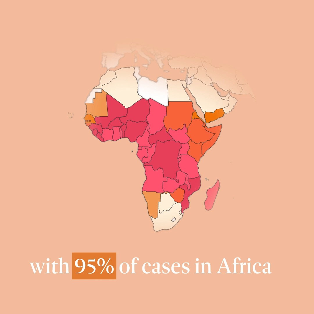 Why a malaria vaccine is absolutely vital: - 247 million malaria cases in 2021 - 619,000 deaths worldwide - 77% of deaths were children under 5 #OxfordVaccine