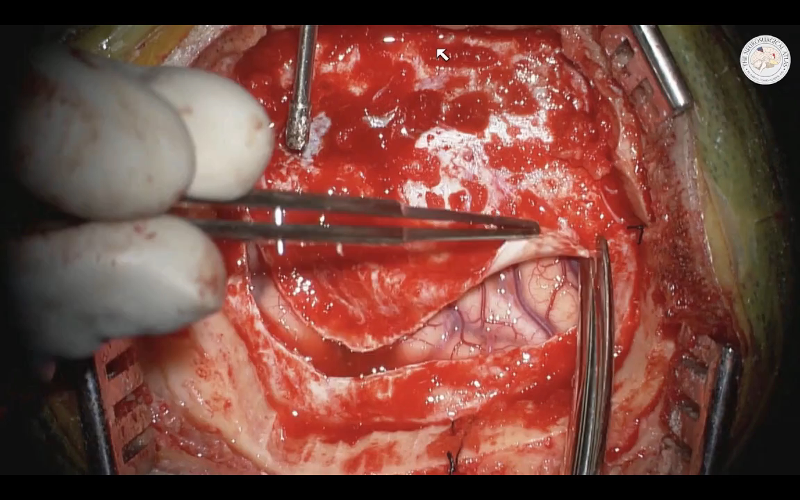 Watch as Dr. Cohen demonstrates resection of a medial parieto-occipital glioma. Learn more here: #MedTwitter #Neurosurgery #NSGY #surgery