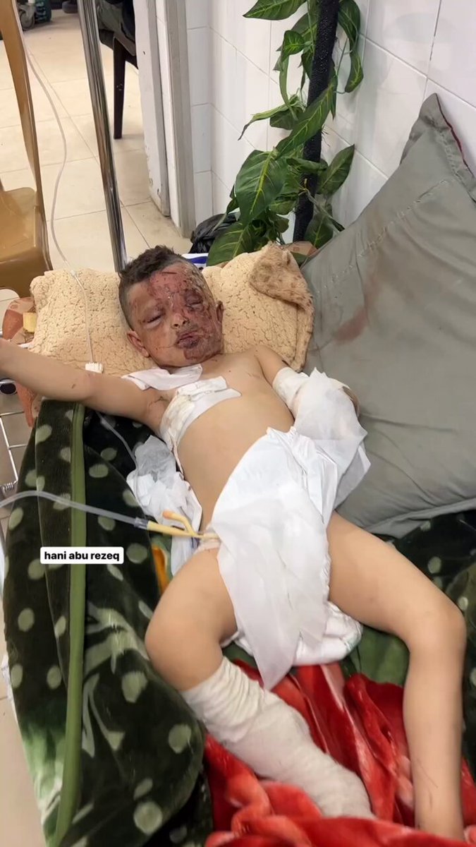 Bu çocuğun adı "Ömer" tüm ailesini kaybetti ver geriye bir tek o kalmış, bir kolunu kaybetmiş çok acil tedaviye ihtiyacı var, Allah razısı için Ömer'in sesi olun Dr. Fahrettin Koca