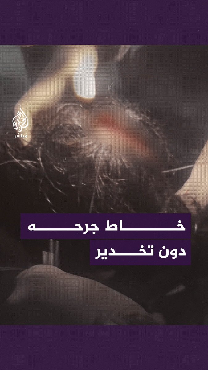 طبيب يخيط جرحًا برأس طفل فلسطيني دون تخدير، في ظل الحصار الخانق على قطاع غزة