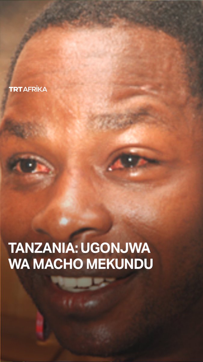 Zaidi ya watu 50 wameripotiwa kupata maambukizi ya ugonjwa wa macho mekundu (Red Eye) jijini Dodoma nchini Tanzania. Kwa mujibu wa Mratibu wa huduma za macho Mkoa wa Dodoma Elizabeth Kiula, ambae amesema wagonjwa hao ni kutoka Wilaya mbili za Chamwino na Dodoma mjini.