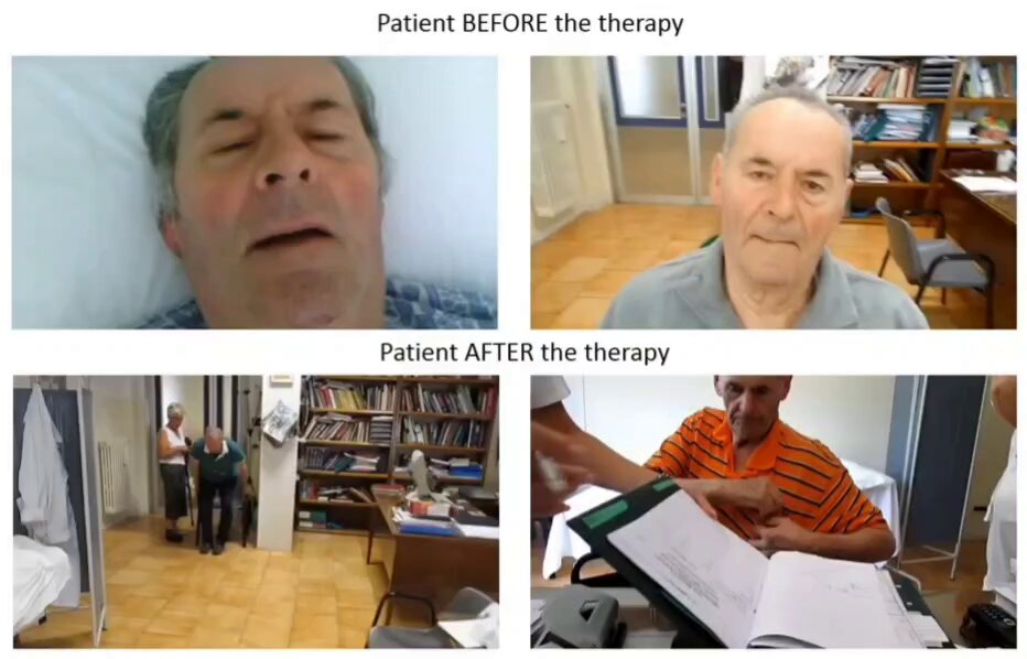 A dementia patient before and after high dose thiamine therapy.