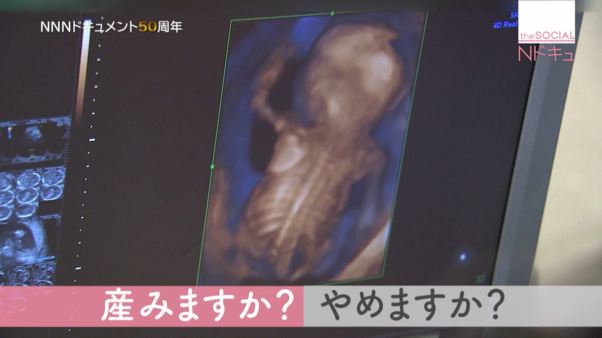 ダウン症は生むべきではない と話題になってるが この動画みたいな人もいる 考えは人それぞれだから 押し付けても荒れるだけ