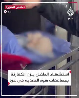 بعد فقدان حاد للوزن.. استشهاد الطفل يزن الكفارنة بمستشفى أبويوسف النجار في رفح بسبب مضاعفات سوء التغذية