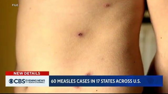 At least 60 measles cases have been confirmed or suspected in 17 states, with data showing a decline in vaccinations nationwide since 2019. In Chicago, a mass vaccination effort is underway at the city’s largest migrant shelter, which has been significantly hit by the outbreak.