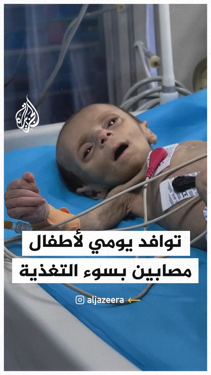 استمرار توافد الأطفال المصابون بسوء التغذية إلى مستشفى كمال عدوان في #غزة #حرب_غزة
