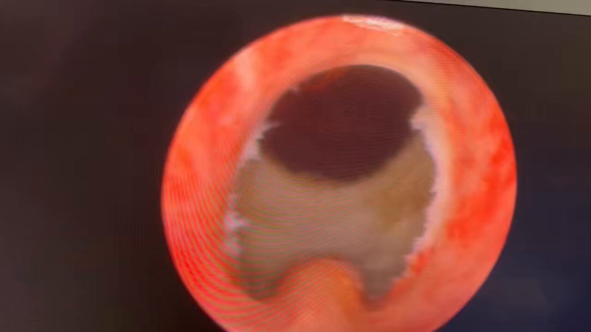 Nowadays we have many options to treat a 50g obstructive prostate… But it is very difficult to beat a MiLEP 18F: - No urethral trauma - Lifetime durability - 18h catheter time - 20h hospital stay And - The Perfect Sphincter 😍