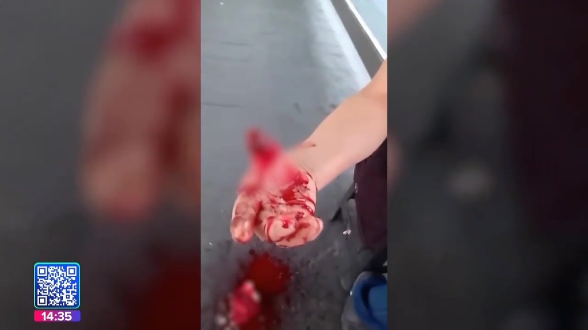 #Terrible 🚨|| Una mujer sufrió la amputación de un dedo, luego de que quedara atorado en una puerta del #RUTA. #JuanCarlosValerioNoticias #NoticiasPuebla #Puebla
