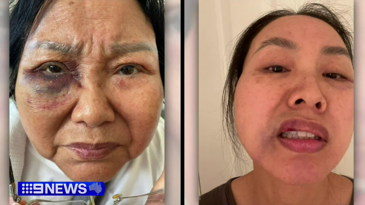 A grandmother has a broken shoulder and bleeding on the brain after she and her daughter were attacked by a stranger outside Melbourne Zoo. The man threw punches in front of children, following an argument over a parking spot. Lana Murphy #9News
