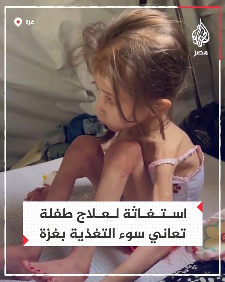استغاثة لعلاج طفلة فلسطينية بغزة تعاني سوء التغذية نتيجة عدوان الاحتلال على القطاع