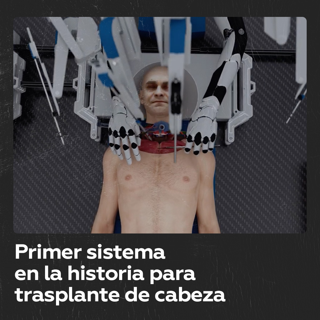Un innovador sistema de trasplante de cabeza fue presentado, prometiendo unir la cabeza del paciente a un cuerpo donante.