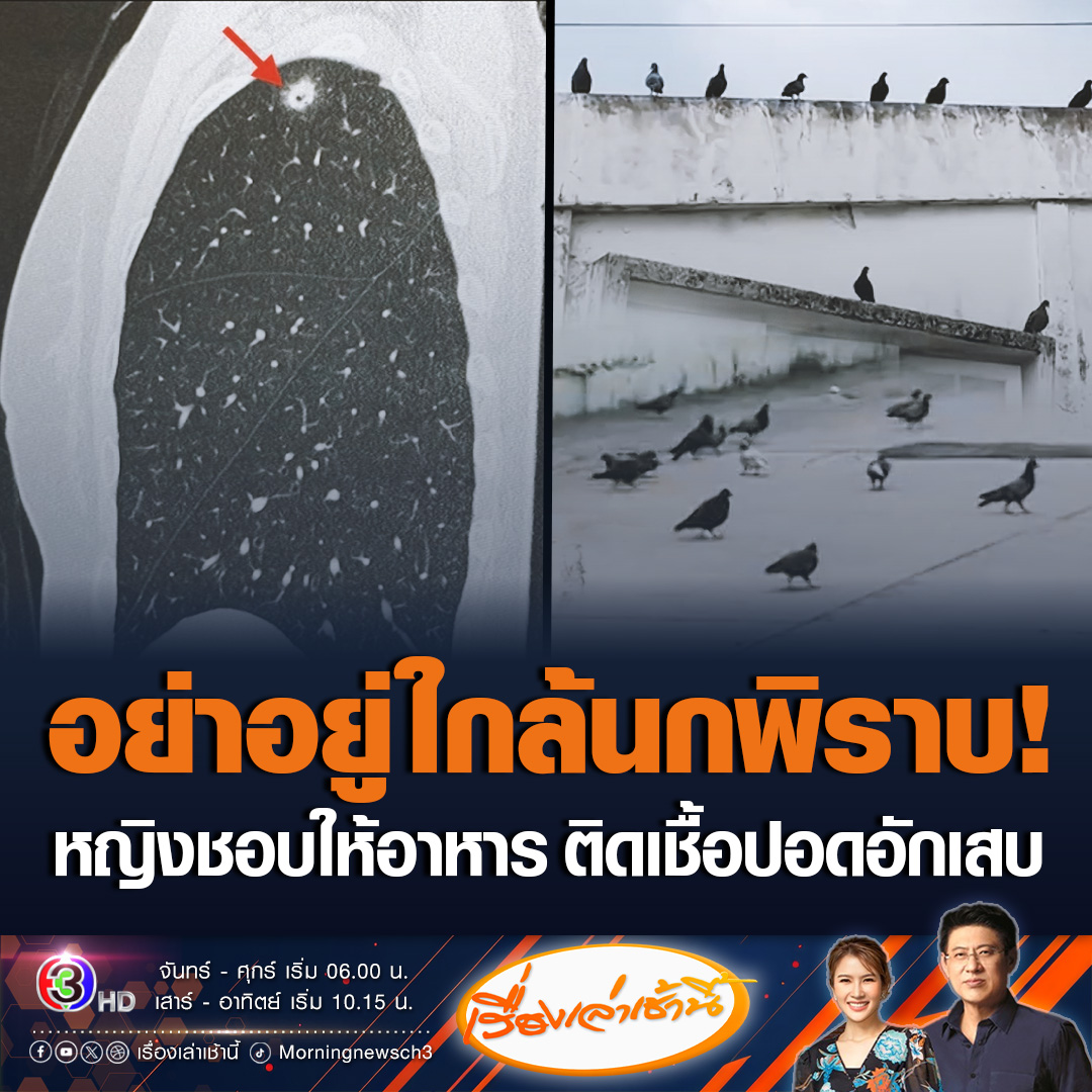 #เรื่องเล่าเช้านี้ นพ.มนูญ เผยข้อมูล พบผู้ป่วยหญิงวัย 52 ปี สุขภาพแข็งแรง แต่ให้อาหารนกพิราบเป็นประจำ จึงหายใจเอาสปอร์ของเชื้อราคริปโตคอคคัส จากมูลนกพิราบเข้าไปในปอด ทำให้เกิดปอดอักเสบ แนะให้อยู่ห่าง และหลีกเลี่ยงให้อาหารนกพิราบ #ข่าวช่อง3 #ข่าวสังคม #นกพิราบ