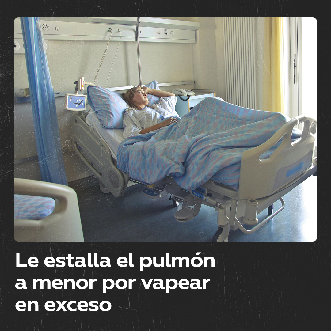 Chica pierde un pulmón por uso excesivo de un vapeador En Reino Unido, una joven de 17 años perdió un pulmón que colapsó después de que fumara el equivalente a 57 cigarrillos en un día, utilizando un vapeador