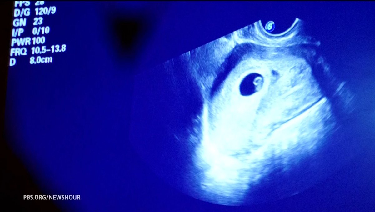 Every year, about 1 million pregnancies in the U.S. end in a miscarriage. In as many as half of those cases, doctors aren't exactly sure why they happened, and experts say stigma and shame are hampering the efforts to learn more about what causes them. Courtney Norris reports.