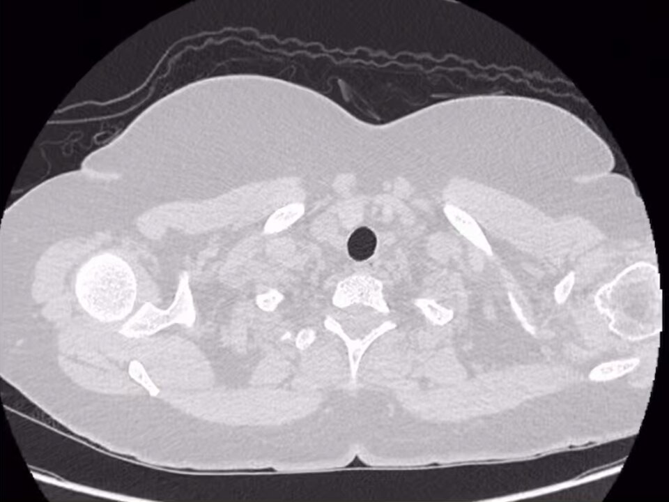 An intriguing HRCT scan of a 44-year-old female patient. 🔍 What anomalies or abnormalities do you see? Drop your observations in the comments below. #MedicalCaseStudy #HRCT #Radiology #MedicalCommunity #CaseDiscussion #XChallenge