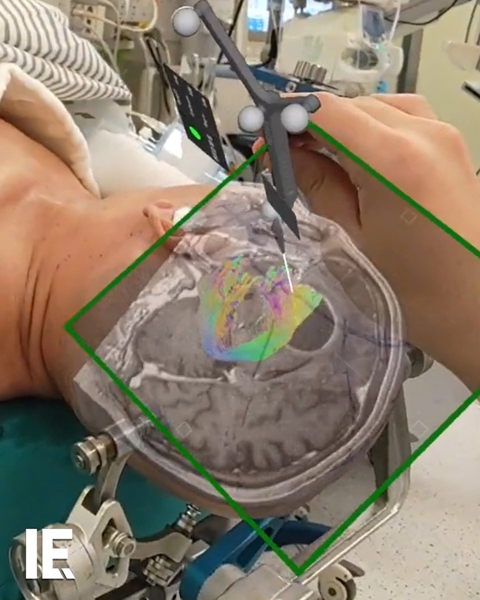 SurgicalAR provides real-time 3D holographic views of patient anatomy, enhancing precision in brain tumor removal while preserving crucial functions, revolutionizing neurosurgery with improved safety and efficacy. 📸: YouTube / @medivisinc.4509