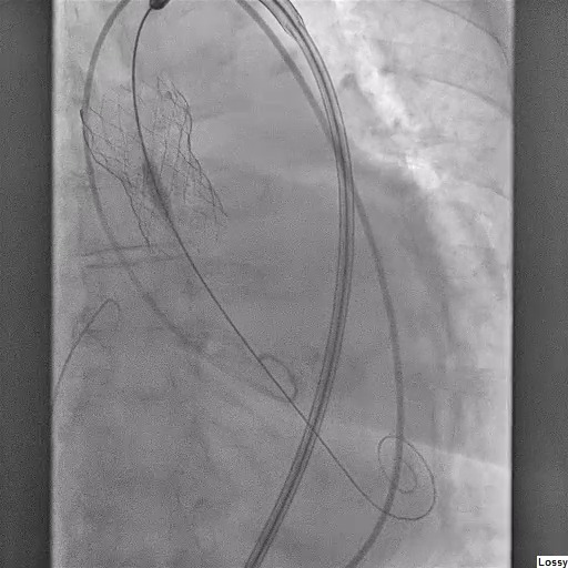 Device embolization is a rare but potentially life-threatening complication of #TAVR procedures. In this #JACCINT case, the very dilated aortic root permitted valve inversion, which was successfully conservatively managed. Learn more: