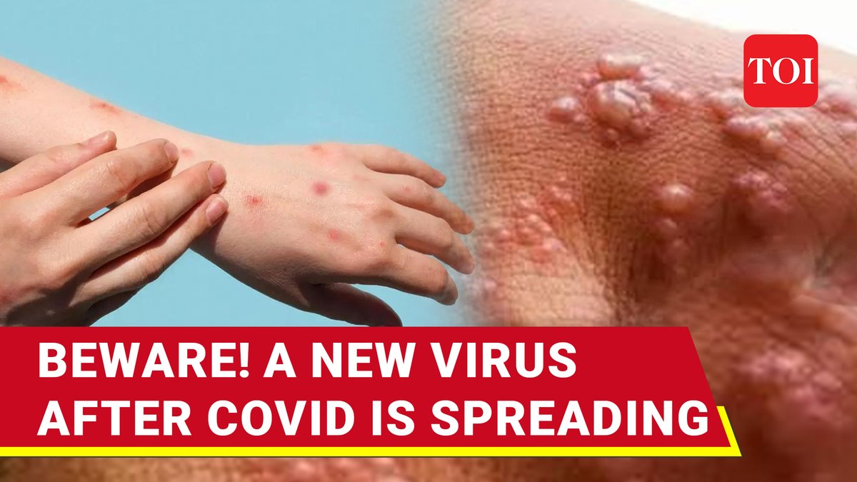 Covid done, new virus emerges: 100s killed, WHO declares global health emergency | Mpox explained