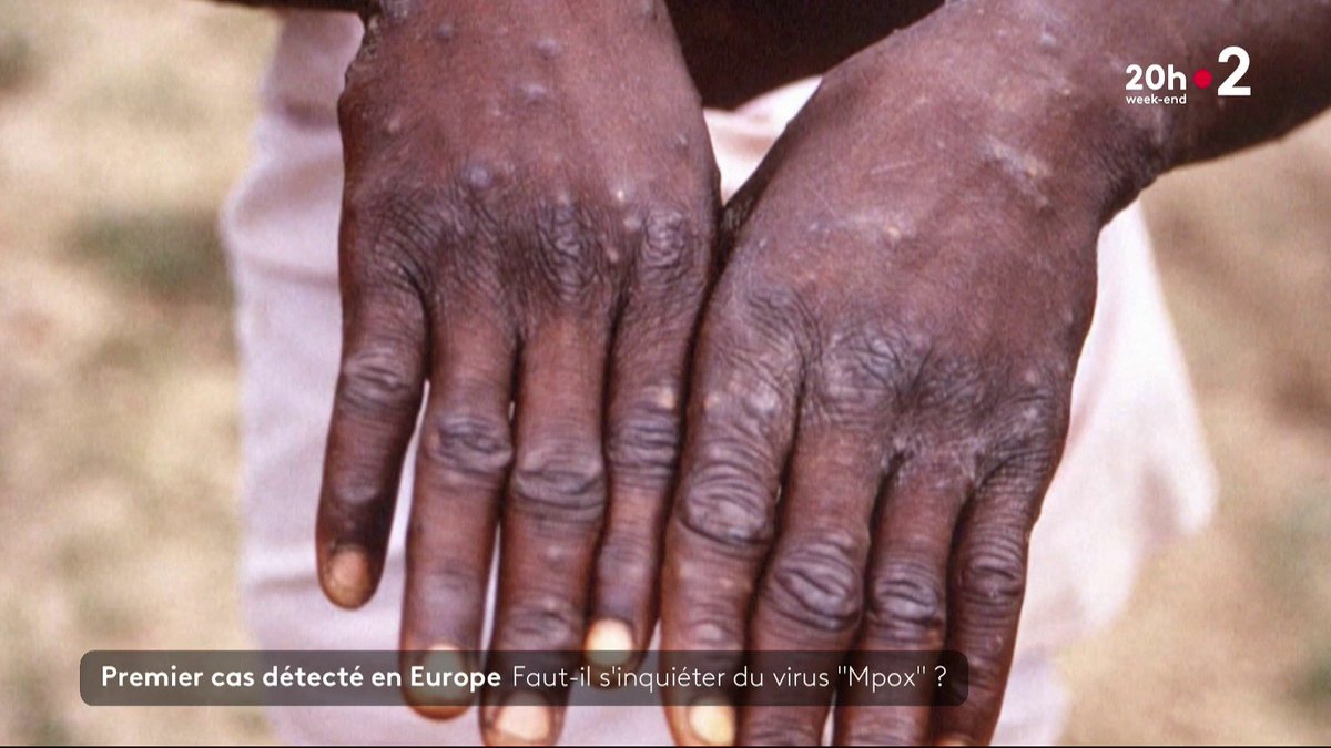 🦠 Quelques modes de contamination du nouveau variant du #Mpox (variole du singe) : - Un baiser prolongé ou un rapport sexuel entre humains - Gouttelettes respiratoires - Objets contaminés - Contact direct avec un animal infecté, comme des rongeurs