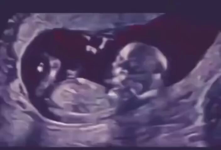 🚨 Veja: l Vídeo mostra bebês se divertindo dentro da barriga durante a gestação