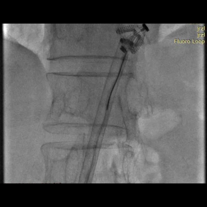 What happens when there is clip embolisation after a TEER of the mitral valve? #EHJCaseReports #echofirst Philipp Sommer Tee Joo YEO Aaysha Cader Boldizsar Kovacs Erik Rafflenbeul A.Nazmi Calik Obayda Azizy Sara Moscatelli EHJCaseReports Editor-in-Chief #CardioX