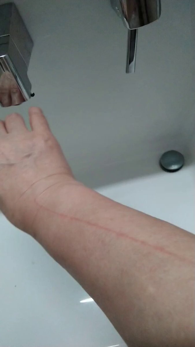 【警察に行った報復❔】 下半身がピリピリと痛痒いと思っていたら、下半身でなく、腕を切ってきた❗ 警察に行った報復⁉️ 警察は、言うまでもなく期待しなくて正解だった😢 結論ありきだった。 #テクノロジー犯罪