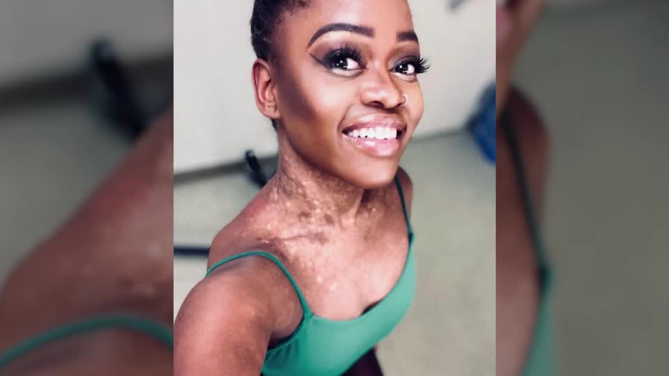 ‘She was an unforgettable inspiration’: Sierra Leonean ballerina Michaela Mabinty DePrince, who starred in the TV show ‘Dancing with the Stars’, died on Friday at the age of 29
