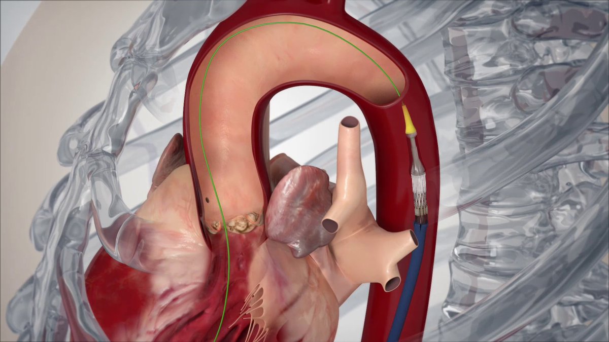 Transcatheter Aortic Valve Implantation (TAVI) is a minimally invasive procedure allowing the replacement of a damaged ❤ heart valve by an artificial bioprosthesis. #TAVI does not require opening the chest. Most patients can leave the hospital in about a few days. #innovation
