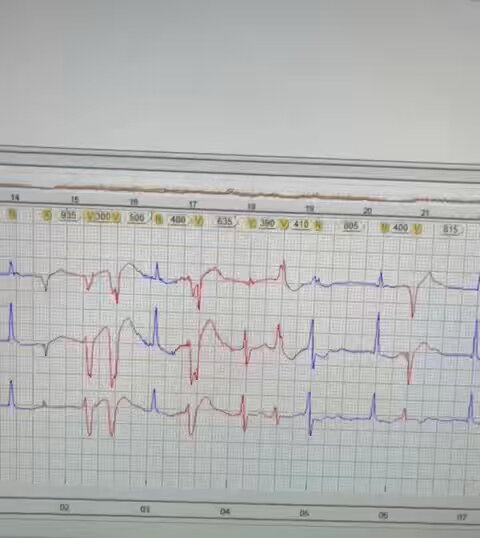 Patient at home using a 24h Holter monitor. Trace reading after his death.