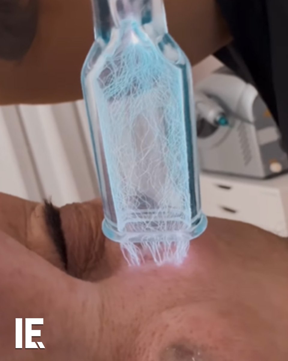Cold plasma uses ionized gas created at room temperature to stimulate the skin's natural healing process. ๐ธ: Instagram / carla.laszlo